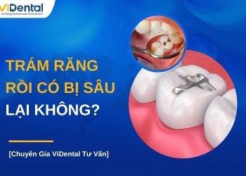 Trám răng rồi có bị sâu lại không