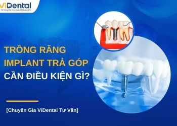 Trồng răng Implant trả góp cần điều kiện gì