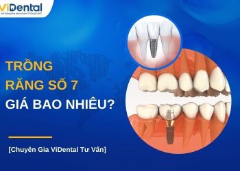 Trồng răng số 7 giá bao nhiêu