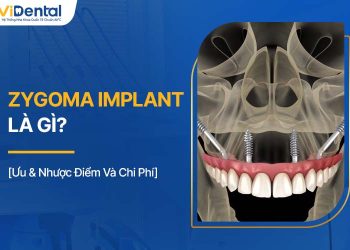 Zygoma Implant Là Gì? Đối Tượng, Ưu & Nhược Điểm Và Chi Phí