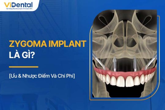 Zygoma Implant Là Gì? Đối Tượng, Ưu & Nhược Điểm Và Chi Phí