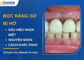 Bọc răng sứ bị hở nguyên nhân do đâu