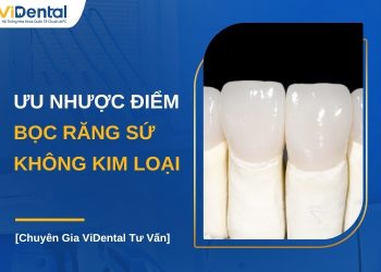 Bọc răng sứ không kim loại có tốt không