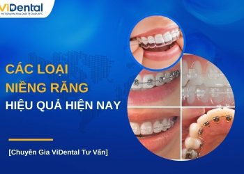 Các loại niêng răng hiệu quả