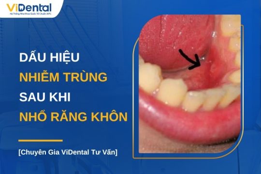 Dấu hiệu nhiễm trùng sau khi nhổ răng khôn