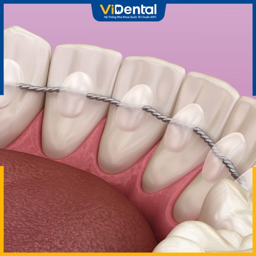 Hàm duy trì cố định được gắn ở mặt trọng để giữ các răng ổn định