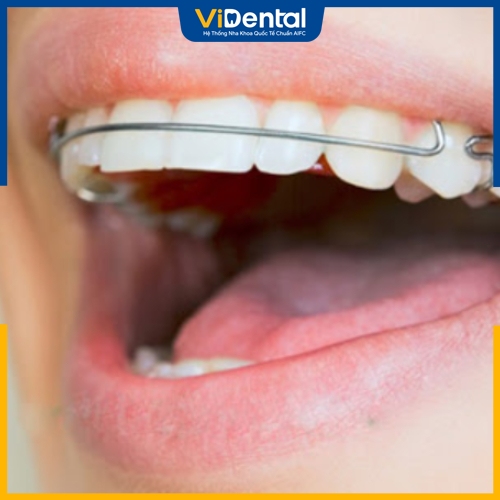 Hàm duy trì Hawley là loại hàm cổ điển giúp răng ổn định sau niềng