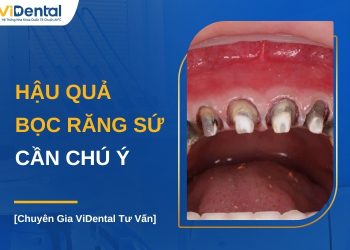 Hậu quả bọc răng sứ cần chú ý