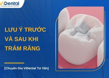 Lưu ý trước và sau khi trám răng