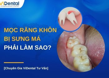 Mọc răng khôn bị sung má phải làm sao