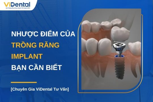 Nhược điểm của trồng răng Implant bạn cần biết