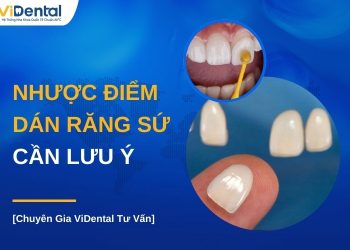 Nhược điểm dán răng sứ cần lưu ý