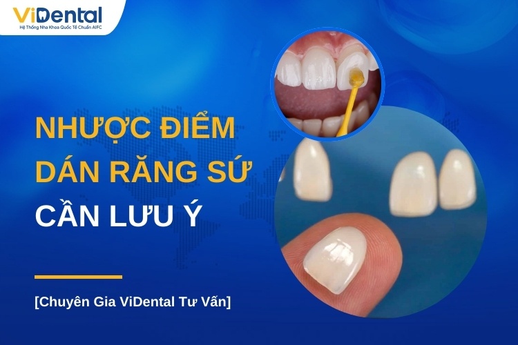 Nhược Điểm Của Dán Răng Sứ Cần Lưu Ý Khi Thực Hiện