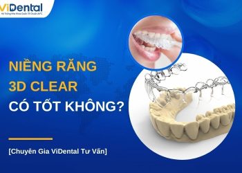 Niềng răng 3D Clear có tốt không