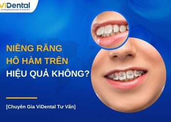 Niềng răng hô hàm trên có hiệu quả không