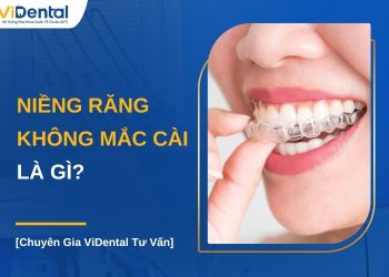 Niềng răng không mắc cài là gì