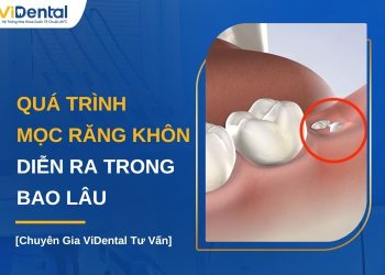 Quá trình mọc răng khôn diễn ra trong bao lâu