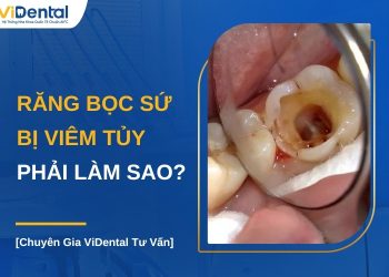 Răng bọc sứ bị viêm tủy phải làm sao