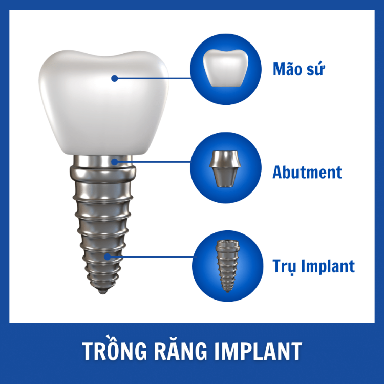 rang-implant (1)