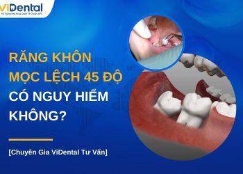 Răng khôn mọc lệch 45 độ có nguy hiểm không