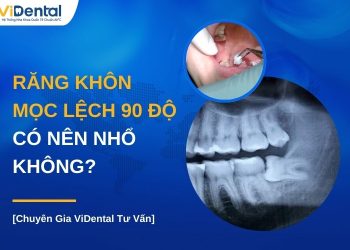 Răng khôn mọc lệch 90 độ có nên nhổ không