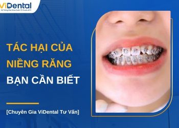 Tác hại của niềng răng bạn nên biết