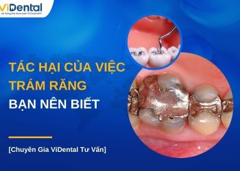 Tác hại của việc trám răng bạn nên biết