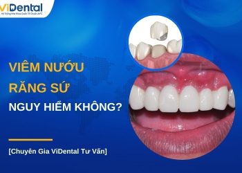 Viêm nướu răng sứ nguy hiểm không