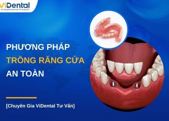 phương pháp trồng răng cửa an toàn