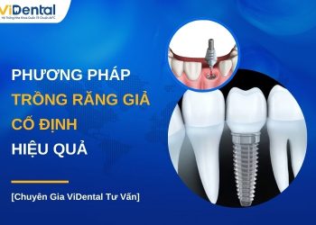 Phương pháp trồng răng giả cố định hiệu quả