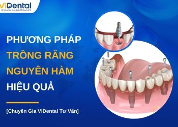 Phương pháp trồng răng nguyên hàm hiệu quả