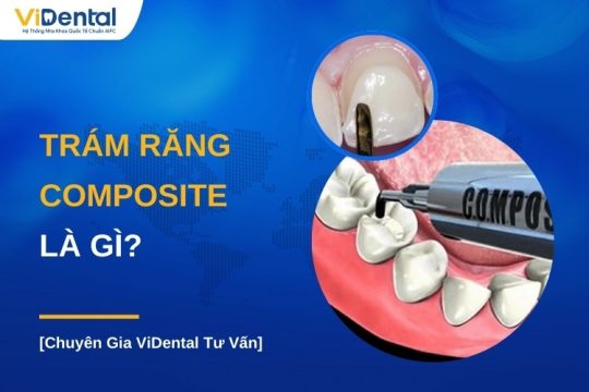 Trám răng composite là gì