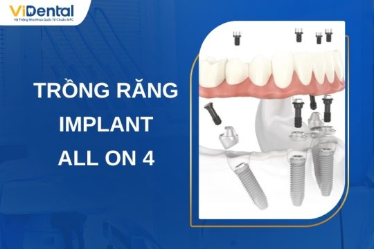 Trồng Răng Implant All On 4