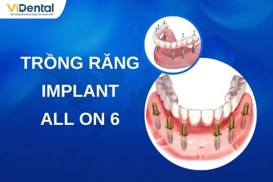 Trồng Răng Implant All On 6