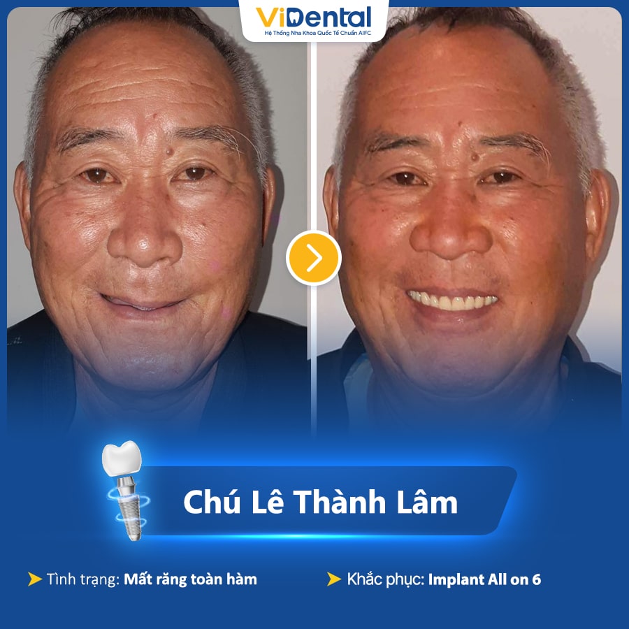 Hình ảnh chú Lâm trước và sau khi trồng răng Implant tại ViDental