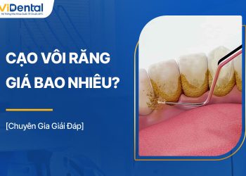 Cạo Vôi Răng Giá Bao Nhiêu? Yếu Tố Ảnh Hưởng Tới Mức Giá