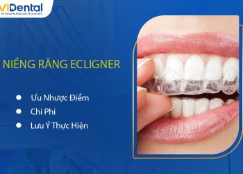 Niềng Răng Ecligner: Ưu Nhược Điểm, Chi Phí, Lưu Ý Thực Hiện