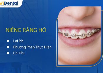 Niềng Răng Hô: Lợi Ích, Phương Pháp Thực Hiện Và Chi Phí