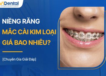 Các Phương Pháp Niềng Răng Mắc Cài Kim Loại Bao Nhiêu Tiền?