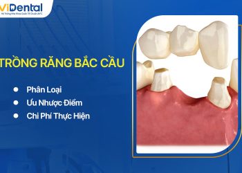 Trồng Răng Bắc Cầu: Phân Loại, Ưu Nhược Điểm, Chi Phí Thực Hiện