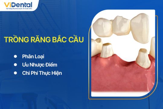 Trồng Răng Bắc Cầu: Phân Loại, Ưu Nhược Điểm, Chi Phí Thực Hiện