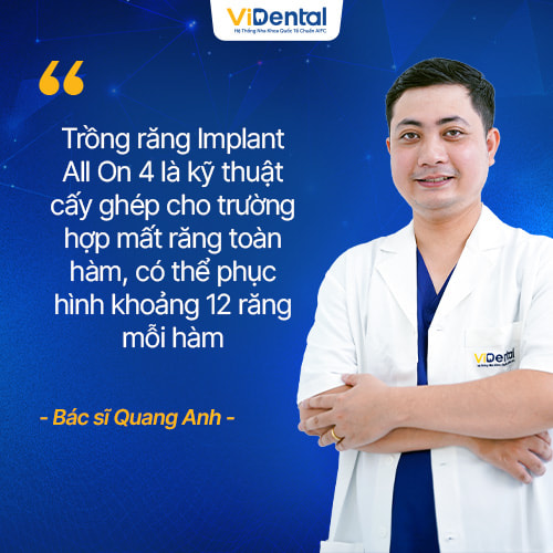 Trồng răng Implant All On 4 có thể phục hình 12 răng mỗi hàm
