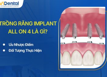 Trồng Răng Implant All On 4: Ưu Nhược Điểm, Đối Tượng Thực Hiện