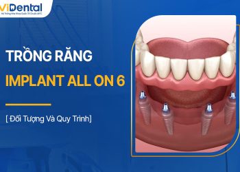 Trồng Răng Implant All On 6 Là Gì? Đối Tượng Và Quy Trình