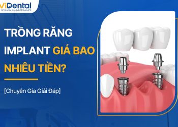 Trồng Răng Implant Giá Bao Nhiêu? Mẹo Tiết Kiệm Chi Phí