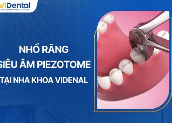 Nhổ răng siêu âm Piezotome tại Nha khoa ViDental