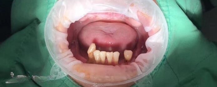 Tình trạng răng của chú Vọng trước khi trồng răng implant