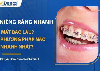 Niềng Răng Nhanh Mất Bao Lâu? Phương Pháp Nào Nhanh Nhất?