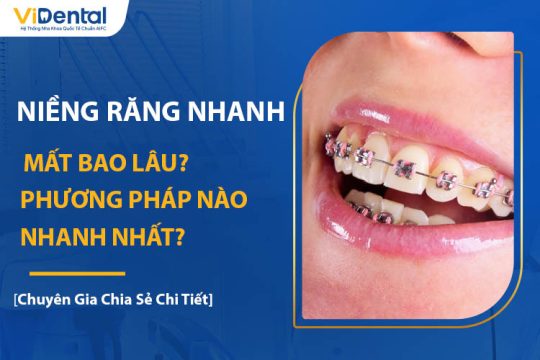 Niềng Răng Nhanh Mất Bao Lâu? Phương Pháp Nào Nhanh Nhất?