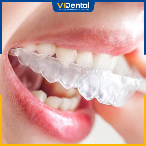 Niềng răng Invisalign được nhiều người lựa chọn